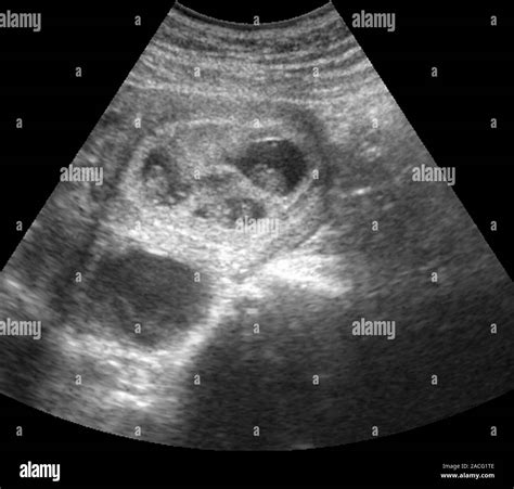 Twin foetuses. Ultrasound scan of twin foetuses (upper centre and left ...