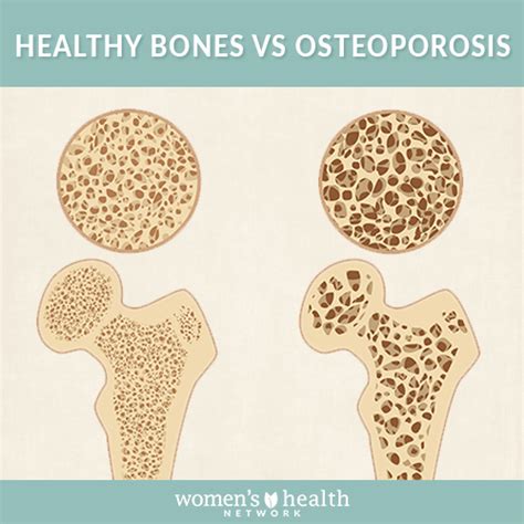 Osteoporosis Symptoms Causes Treatments What Every Woman Needs To