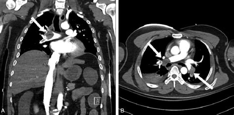 Chest Computed Tomography Scan Showing Extensive Bilateral Pulmonary