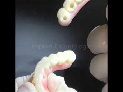 Protocolo em Zircônia Implante Dentário Completo sem Metal YouTube