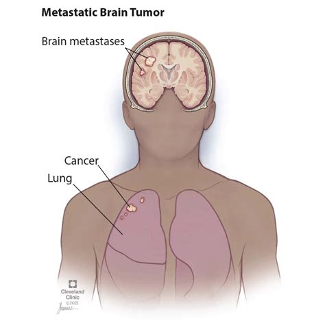 Brain Metastases When Cancer Spreads To The Brain