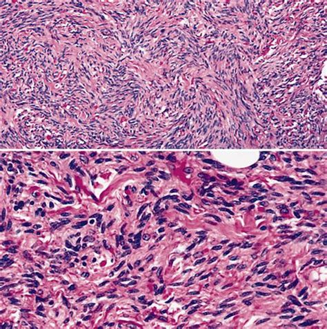 Pathology Outlines Spindle Cell Pleomorphic Lipoma