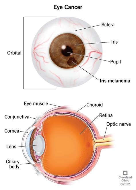 Understanding Eye Cancer Causes Symptoms And Treatments Ask The