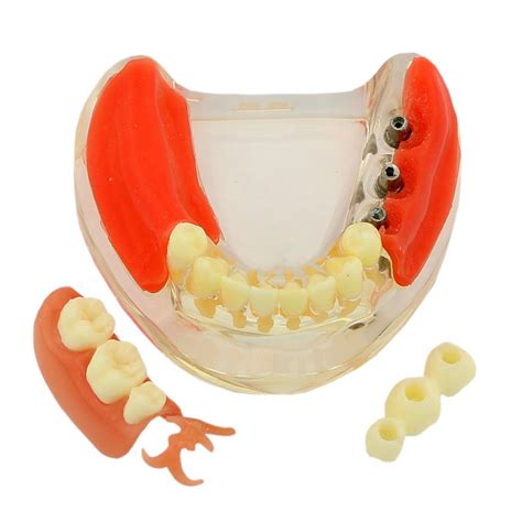 Unilateral Removable Partial Denture