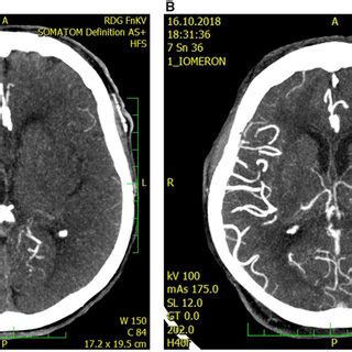 Ct Angiography Of The Left Middle Cerebral Artery Occlusion With Poor