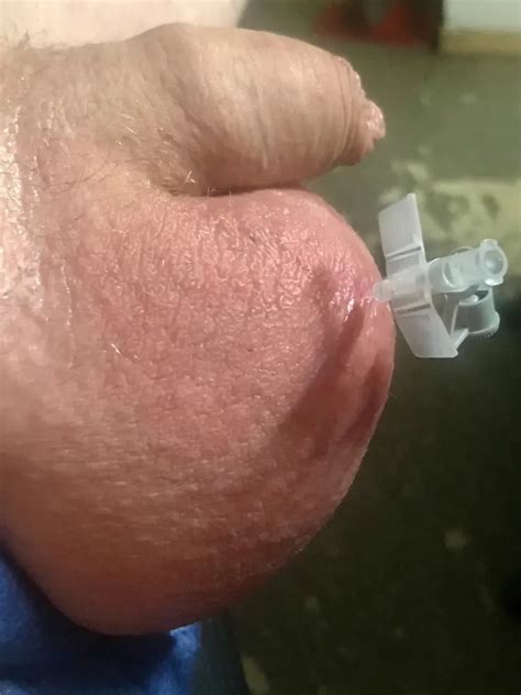 Saline Infusion 14 Nude Pics XHamster