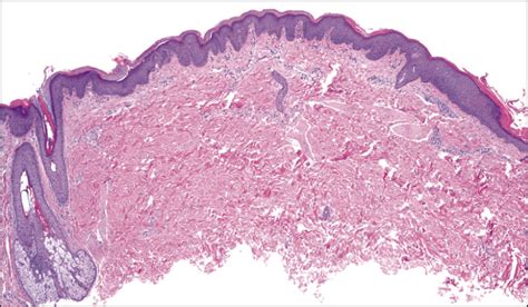 Confluent Scaly Erythematous Plaques On The Trunk Of A 16 Year Old Boy—quiz Case Dermatology