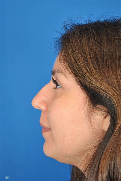 Hollywood Spectra Laser Before And After Aesthetic Specialists