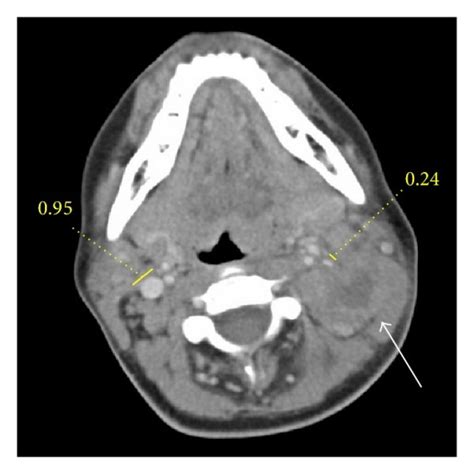 Computed Tomography Scan Of The Neck Without Contrast Showing Enlarged Download Scientific