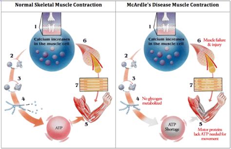 Mcardle S Disease Physiopedia