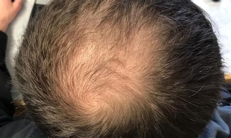 Androgenetic Alopecia