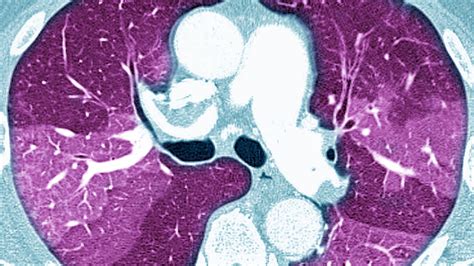 Certain Medications Tied To Post Covid Pulmonary Fibrosis Medpage Today