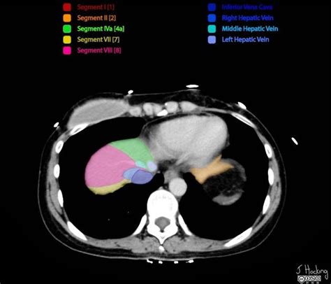 Couinaud Classification Of Hepatic Segments Radiology Reference