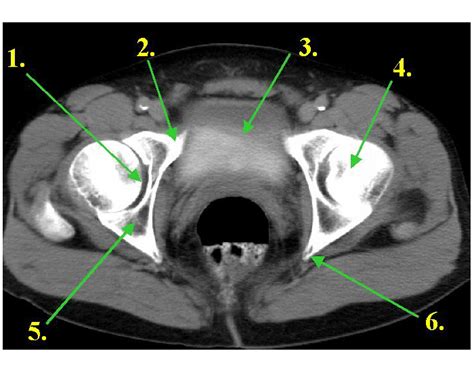 Acetabulum and Superior Pubic Ramus Quiz