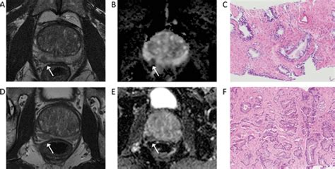 Prostate Mri Based On Pi Rads Version 2 How We Review And 47 Off