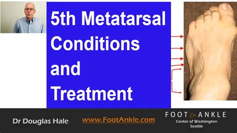 Tuberosity Of 5th Metatarsal Pain