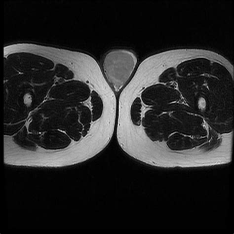 Testicular Seminoma Image