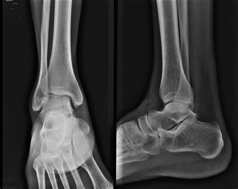 Xknee Startradiology Radiology Avulsion Fracture