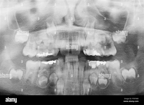 Kids Teeth X Ray