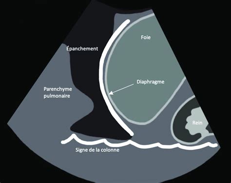 Schéma échographique d un épanchement pleural Le signe de la colonne