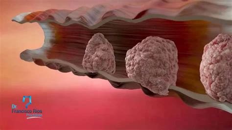 Qué es una Fisura Anal Dr Francisco Ríos