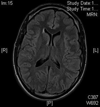 48 XXYY Syndrome Associated Tremor Practical Neurology