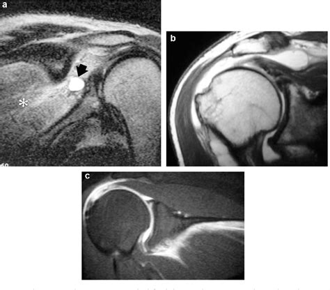 Figure 2 From Rotator Cuff Tear Imaging In Patients Over 70 Years Specific Mri Findings