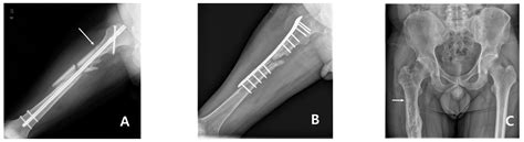 Subtrochanteric Insufficiency Fracture Occurring 5 Years After Surgery