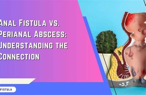 Causes Of Anal Fistula Complete Guide For Prevention Care