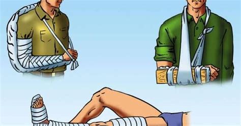 4 Особливості накладання шин на верхню та нижню кінцівки | Урок на 3 ...