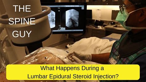 Lumbar Epidural Steroid Injection Animation At Don Maggie Blog