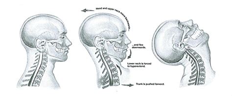 Whiplash Injuries Explained — Craniocervical Foundation