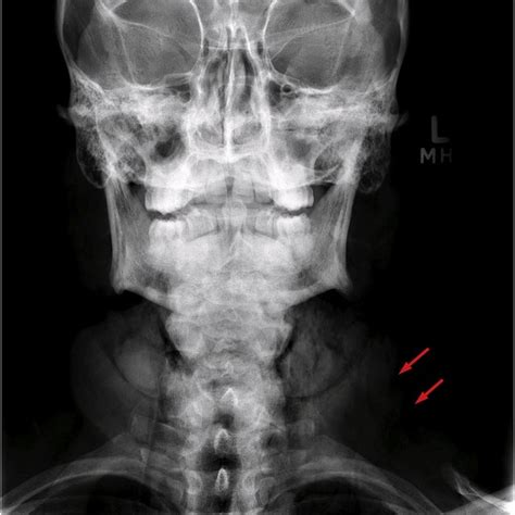 Subcutaneous Emphysema In Neck And Upper Chest White Arrows Note