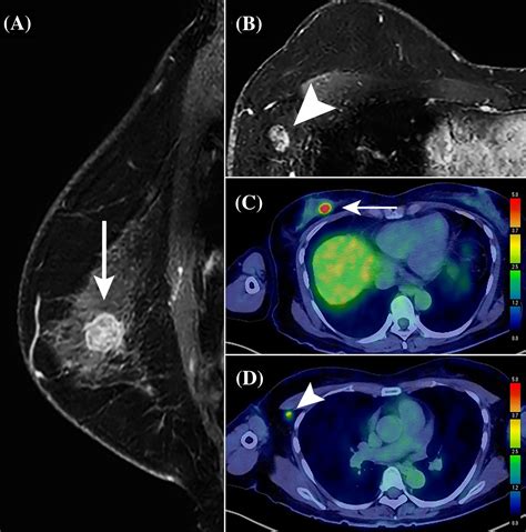 Frontiers Clinical Prediction Model Based On 18F FDG PET CT Plus