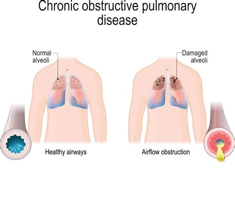 Bronchoscopic Lung Volume Reduction (BLVR) Treatment | Ohio State Medical Center