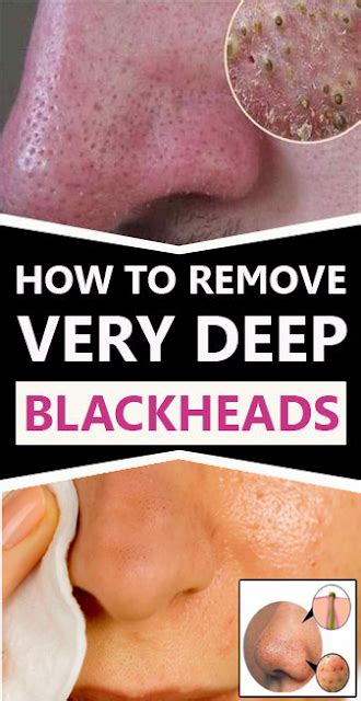 Ways To Get Rid Of Deep Blackheads Healthy Care