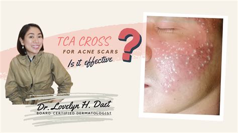 Tca Cross For Acne Scars How Effective Is It Youtube