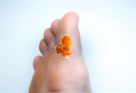 Premium Photo Contagious Skin Illness On Foot Medical Treatment