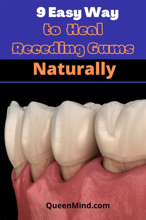 9 Easy Ways To Heal Receding Gums Naturally QueenMind Receding