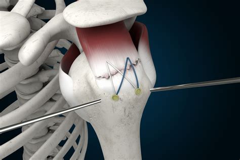 Arthroscopic Rotator Cuff Surgery Youtube At Aaron Smith Blog
