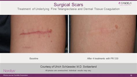 laser scar removal skin cancer clinic melbourne