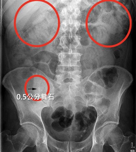 男童忍便半年結糞石 通腸治療終獲一夜好眠 自由健康網