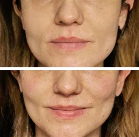Cheek Filler Uses Providers Photos Cost Belorens