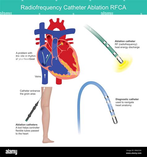 Heart arrhythmia Stock Vector Images - Alamy