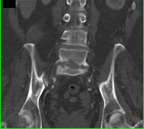 Osteomyelitis L5 S1 Musculoskeletal Case Studies Ctisus Ct Scanning