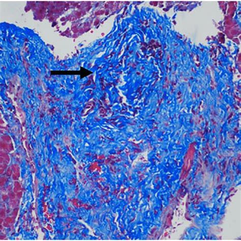 medium sized portal tract shows  interlobular bile duct