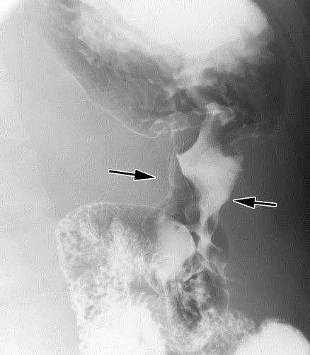 Stomach Cancer Xray