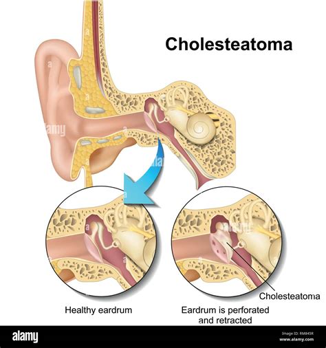 Auditory ossicles hi-res stock photography and images - Alamy