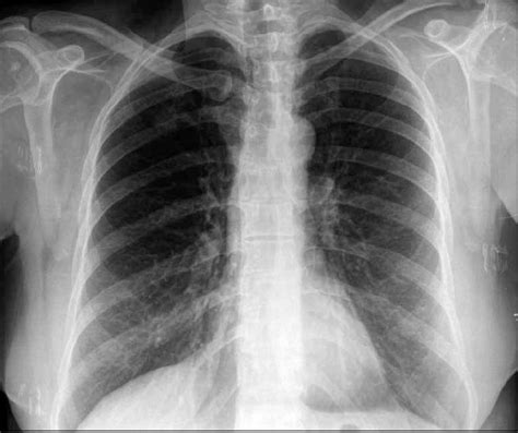 The Postero Anterior Chest X Ray Of The Patient Showing A Round Nodule