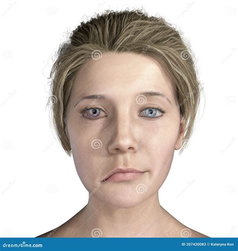 Paralysis Of The Facial Nerve. Bell`s Palsy Vector Illustration